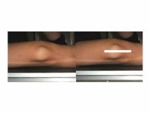 2）足首をタオル等であげて、膝蓋骨の縦軸をカセッテに対して水平にする。